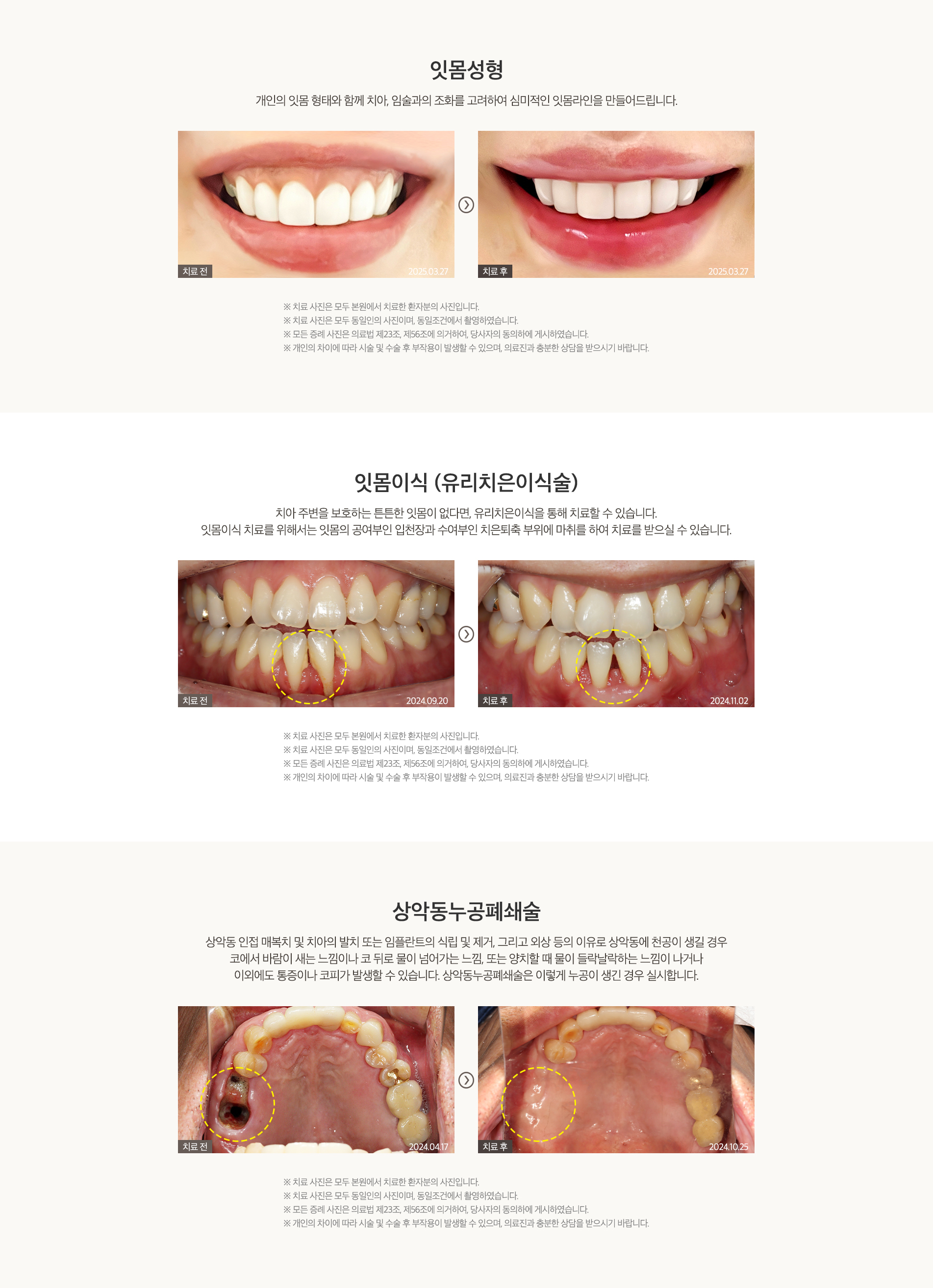 구강내소수술_pc